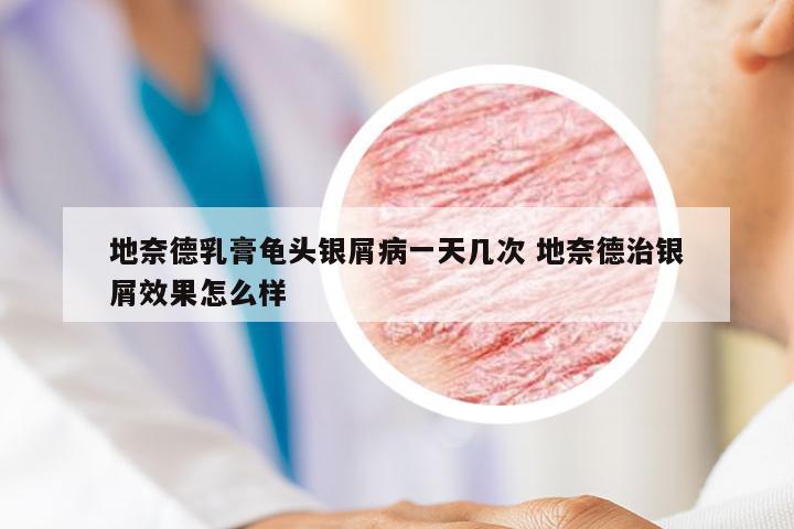 地奈德乳膏龟头银屑病一天几次 地奈德治银屑效果怎么样