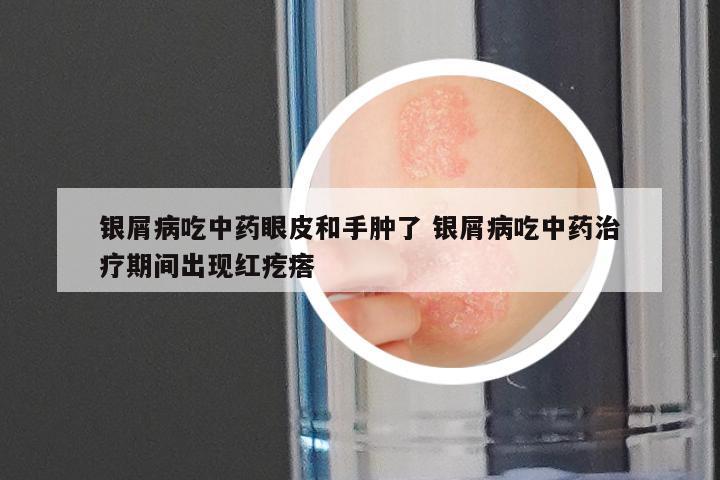 银屑病吃中药眼皮和手肿了 银屑病吃中药治疗期间出现红疙瘩