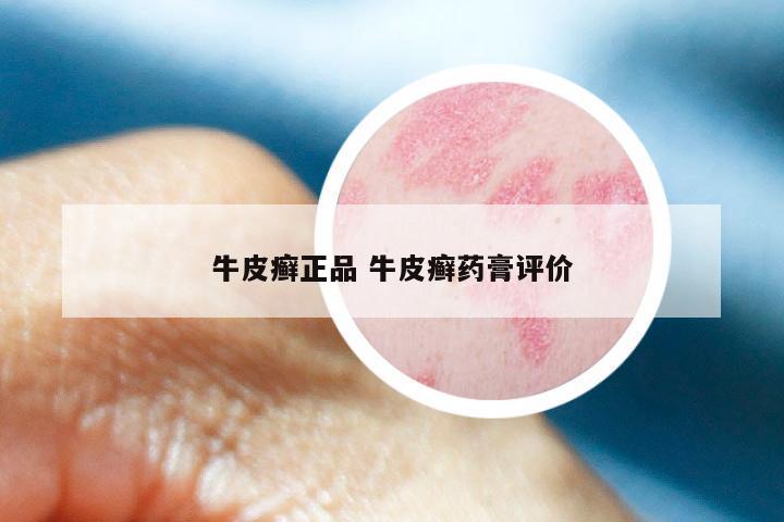 牛皮癣正品 牛皮癣药膏评价