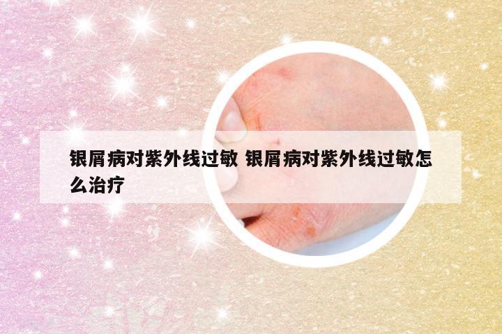 银屑病对紫外线过敏 银屑病对紫外线过敏怎么治疗