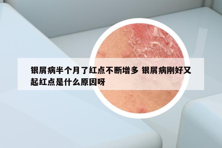 银屑病半个月了红点不断增多 银屑病刚好又起红点是什么原因呀