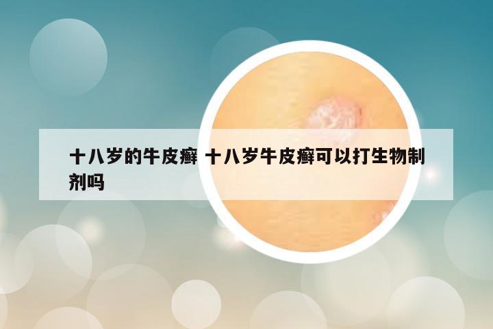 十八岁的牛皮癣 十八岁牛皮癣可以打生物制剂吗