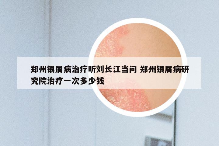 郑州银屑病治疗听刘长江当问 郑州银屑病研究院治疗一次多少钱