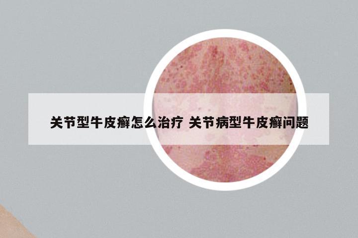 关节型牛皮癣怎么治疗 关节病型牛皮癣问题