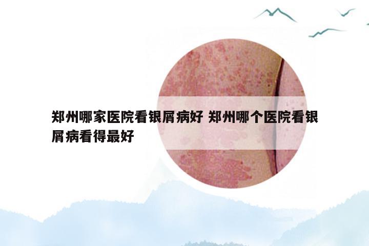 郑州哪家医院看银屑病好 郑州哪个医院看银屑病看得最好