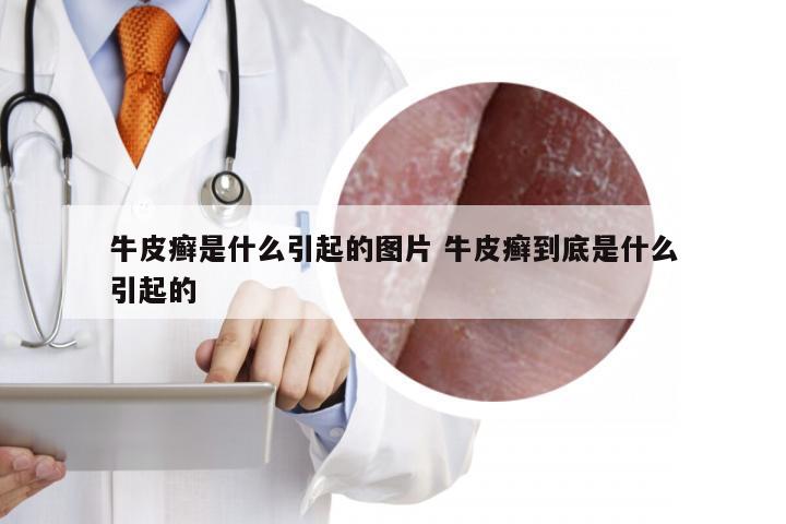 牛皮癣是什么引起的图片 牛皮癣到底是什么引起的