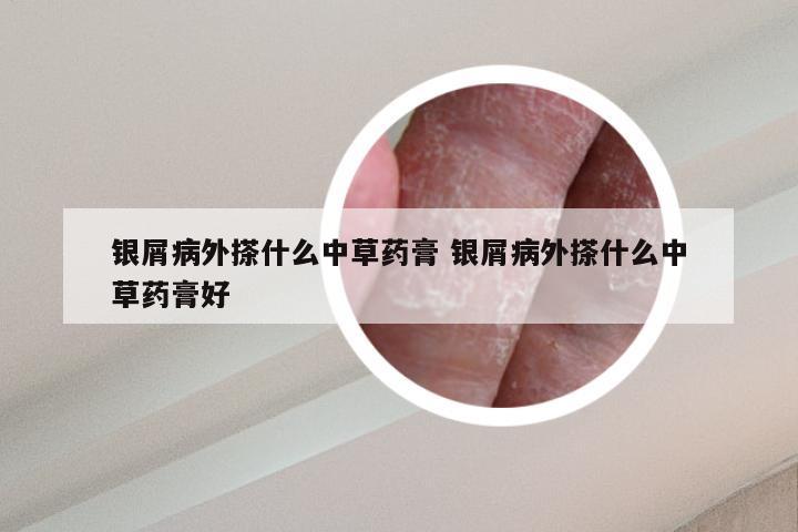 银屑病外搽什么中草药膏 银屑病外搽什么中草药膏好