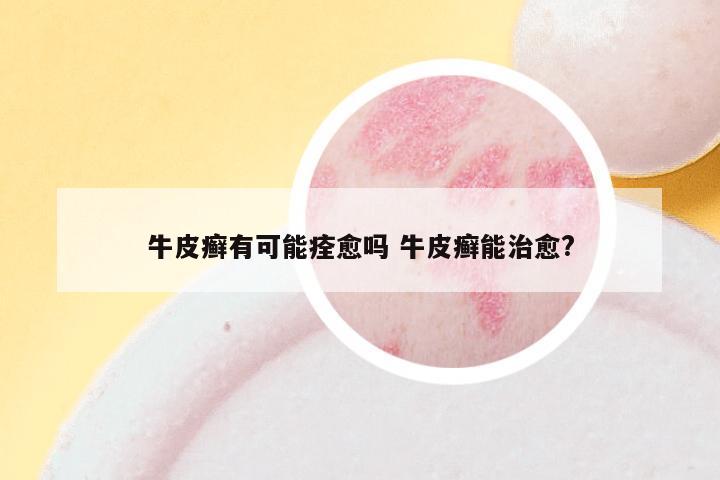 牛皮癣有可能痊愈吗 牛皮癣能治愈?