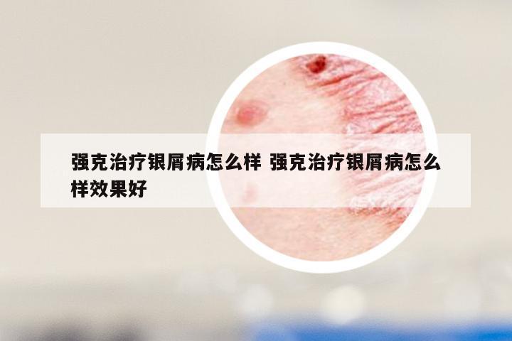 强克治疗银屑病怎么样 强克治疗银屑病怎么样效果好