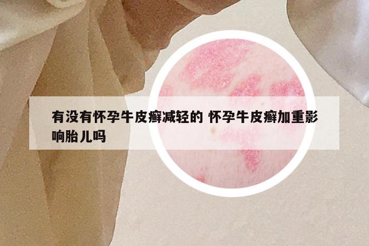 有没有怀孕牛皮癣减轻的 怀孕牛皮癣加重影响胎儿吗