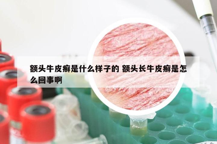 额头牛皮癣是什么样子的 额头长牛皮癣是怎么回事啊