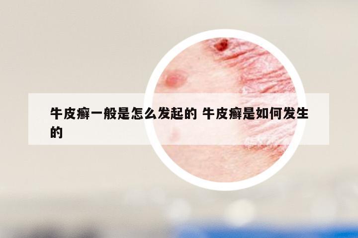 牛皮癣一般是怎么发起的 牛皮癣是如何发生的
