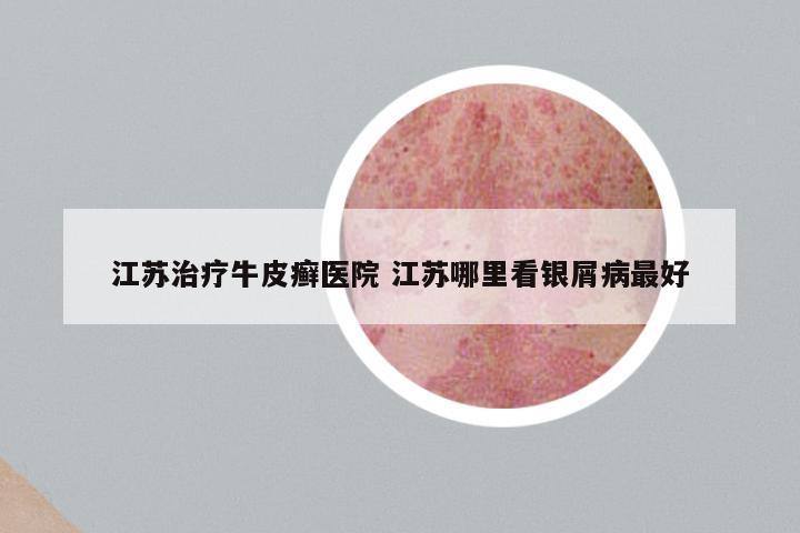江苏治疗牛皮癣医院 江苏哪里看银屑病最好