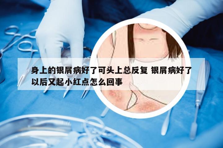 身上的银屑病好了可头上总反复 银屑病好了以后又起小红点怎么回事