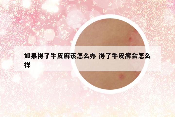如果得了牛皮癣该怎么办 得了牛皮癣会怎么样