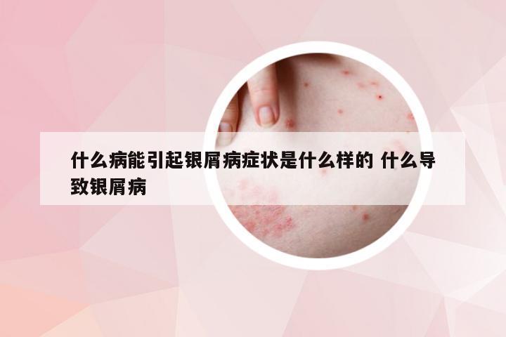 什么病能引起银屑病症状是什么样的 什么导致银屑病