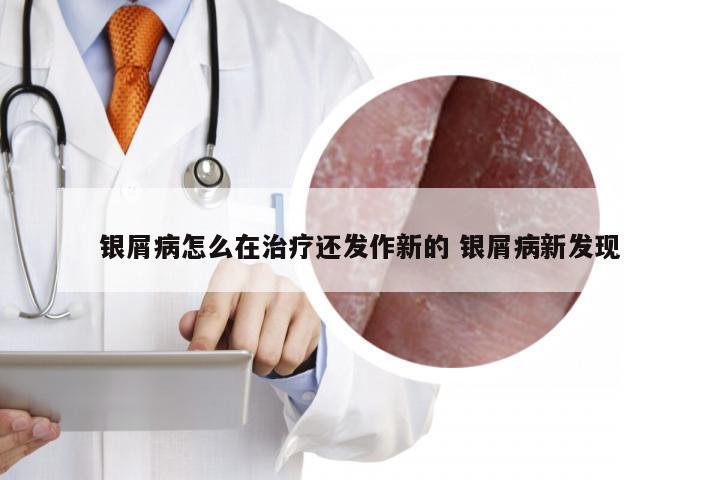 银屑病怎么在治疗还发作新的 银屑病新发现