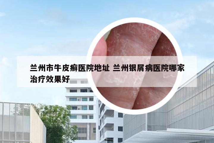 兰州市牛皮癣医院地址 兰州银屑病医院哪家治疗效果好