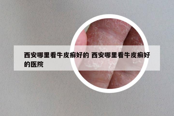 西安哪里看牛皮癣好的 西安哪里看牛皮癣好的医院