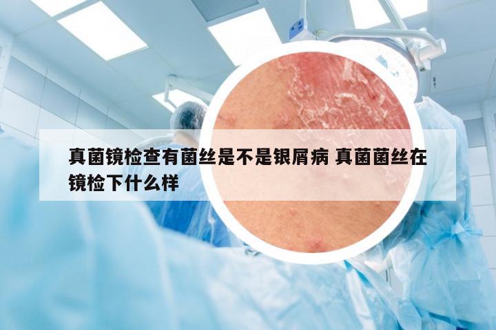 真菌镜检查有菌丝是不是银屑病 真菌菌丝在镜检下什么样