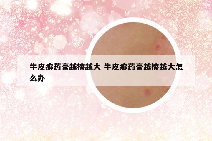 牛皮癣药膏越擦越大 牛皮癣药膏越擦越大怎么办
