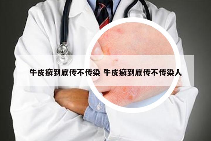 牛皮癣到底传不传染 牛皮癣到底传不传染人