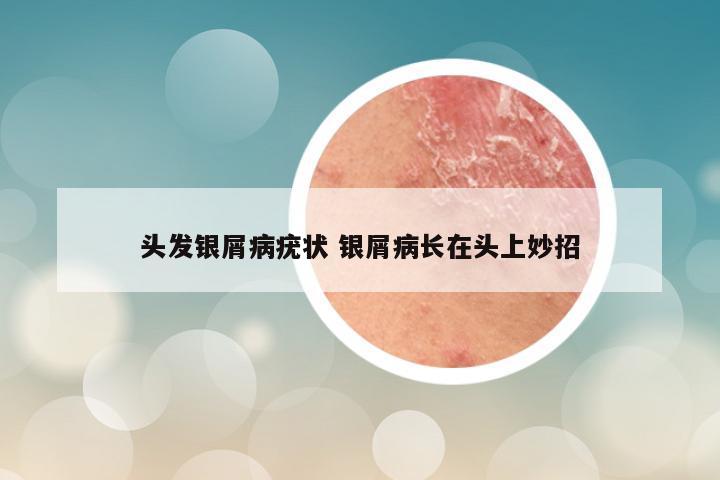 头发银屑病疣状 银屑病长在头上妙招