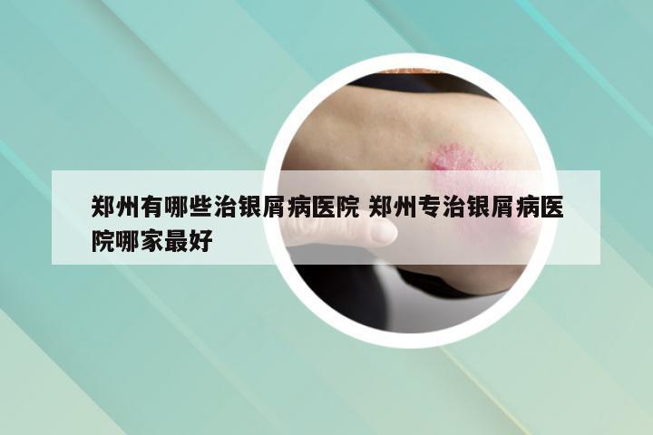 郑州有哪些治银屑病医院 郑州专治银屑病医院哪家最好