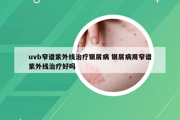 uvb窄谱紫外线治疗银屑病 银屑病用窄谱紫外线治疗好吗