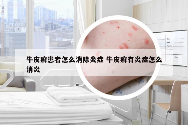 牛皮癣患者怎么消除炎症 牛皮癣有炎症怎么消炎