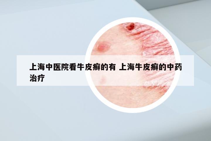 上海中医院看牛皮癣的有 上海牛皮癣的中药治疗