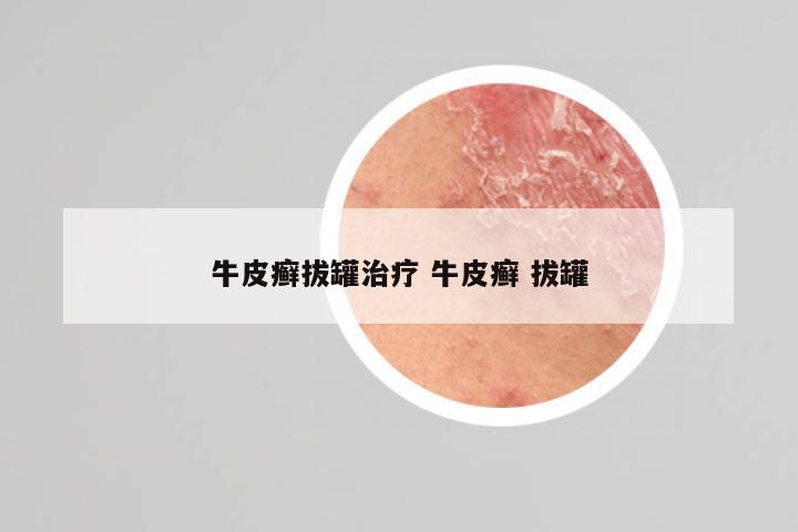 牛皮癣拔罐治疗 牛皮癣 拔罐