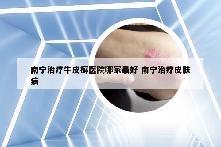 南宁治疗牛皮癣医院哪家最好 南宁治疗皮肤病