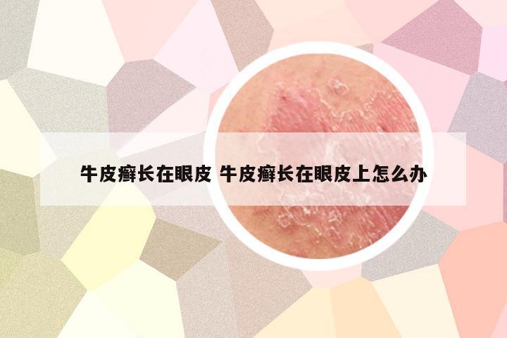 牛皮癣长在眼皮 牛皮癣长在眼皮上怎么办
