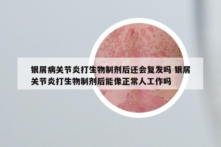 银屑病关节炎打生物制剂后还会复发吗 银屑关节炎打生物制剂后能像正常人工作吗