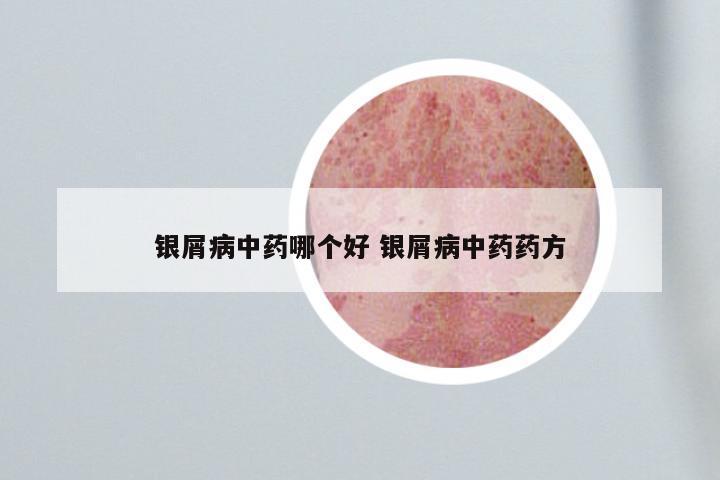 银屑病中药哪个好 银屑病中药药方