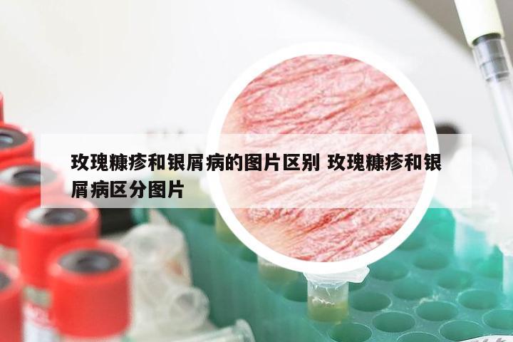 玫瑰糠疹和银屑病的图片区别 玫瑰糠疹和银屑病区分图片