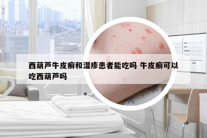 西葫芦牛皮癣和湿疹患者能吃吗 牛皮癣可以吃西葫芦吗