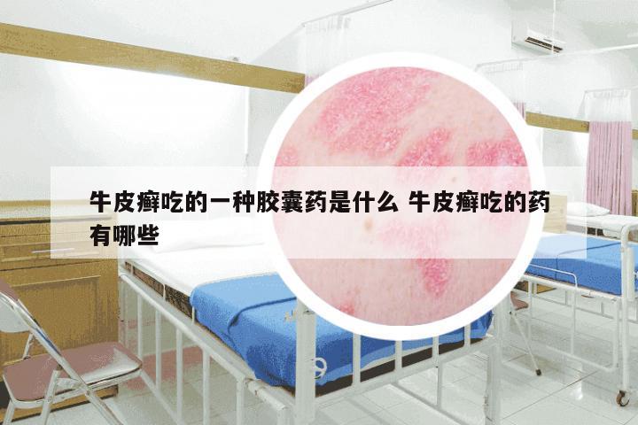 牛皮癣吃的一种胶囊药是什么 牛皮癣吃的药有哪些