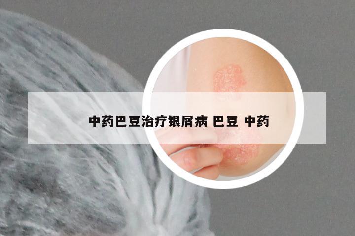 中药巴豆治疗银屑病 巴豆 中药