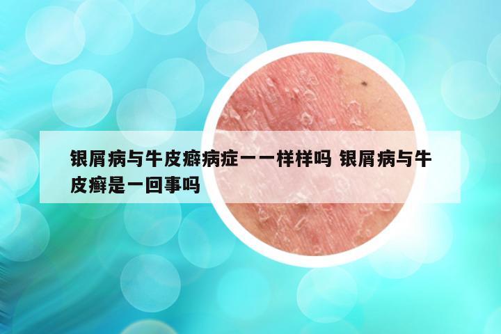 银屑病与牛皮癖病症一一样样吗 银屑病与牛皮癣是一回事吗