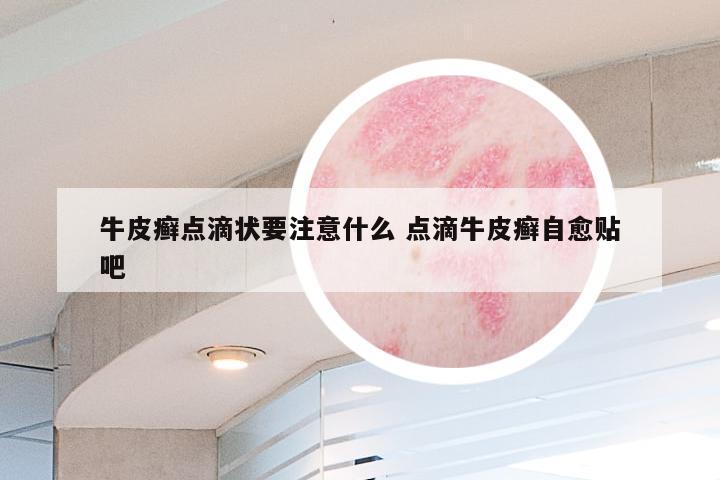 牛皮癣点滴状要注意什么 点滴牛皮癣自愈贴吧