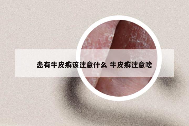 患有牛皮癣该注意什么 牛皮癣注意啥
