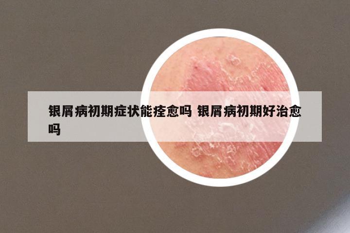 银屑病初期症状能痊愈吗 银屑病初期好治愈吗