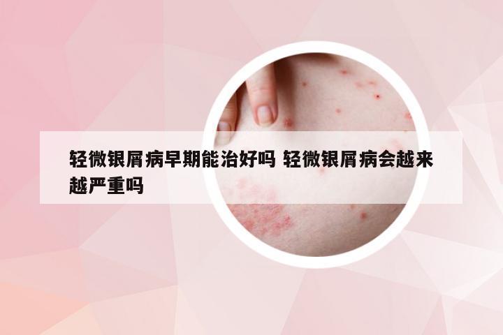 轻微银屑病早期能治好吗 轻微银屑病会越来越严重吗
