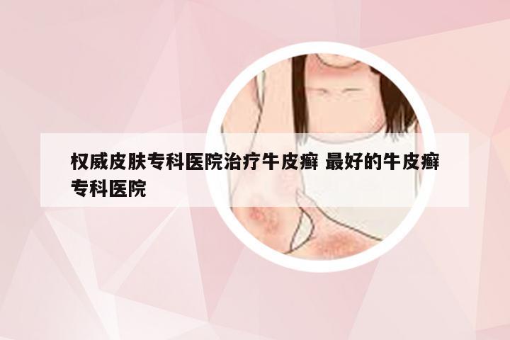权威皮肤专科医院治疗牛皮癣 最好的牛皮癣专科医院