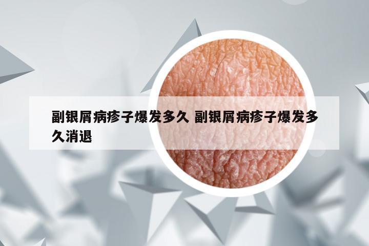 副银屑病疹子爆发多久 副银屑病疹子爆发多久消退