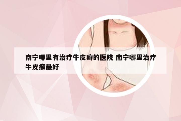 南宁哪里有治疗牛皮癣的医院 南宁哪里治疗牛皮癣最好