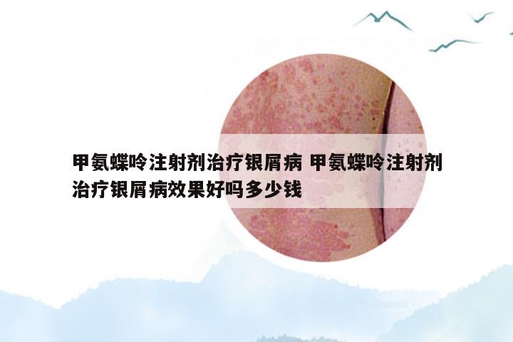 甲氨蝶呤注射剂治疗银屑病 甲氨蝶呤注射剂治疗银屑病效果好吗多少钱