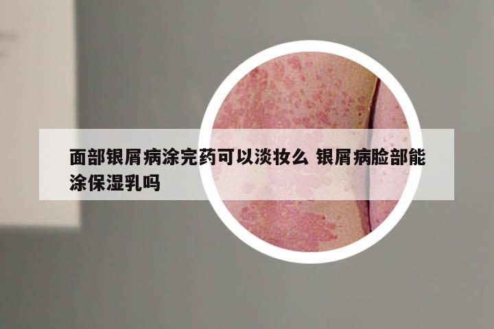 面部银屑病涂完药可以淡妆么 银屑病脸部能涂保湿乳吗